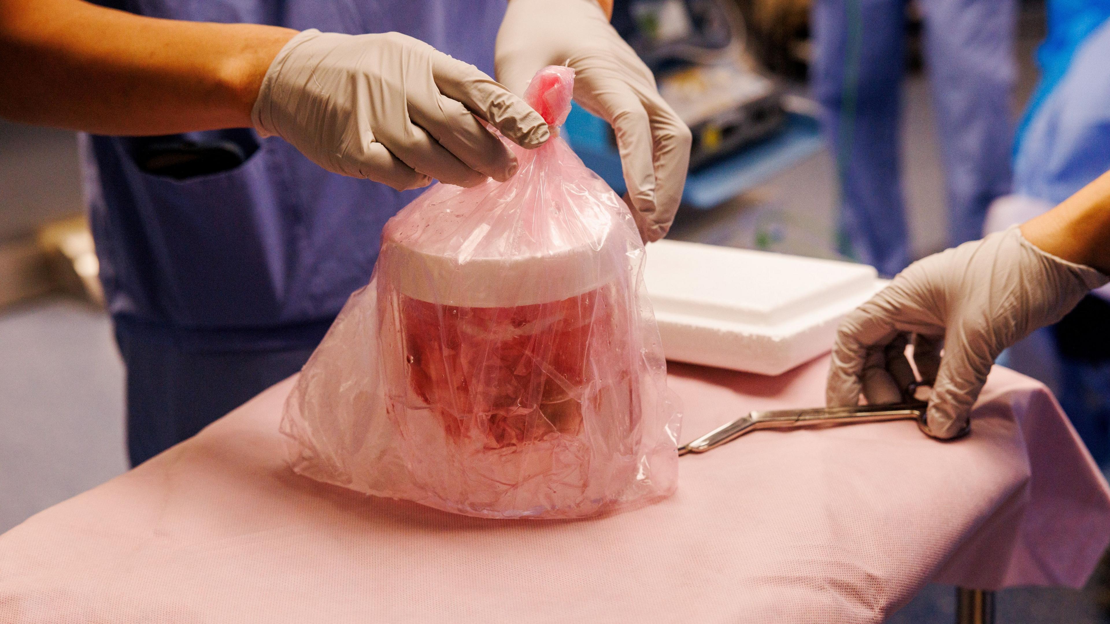 Pig kidney functions in a patient for a record 271 days before being replaced with a human organ