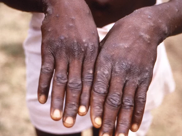 In South Africa, the Mpox outbreak is most prevalent among men