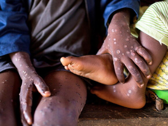 Mpox outbreak endangers DR Congo’s and its neighbors’ regular business