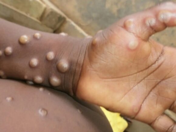 In Goma, DR Congo finds at least 25 instances of mpox, mostly in camps for displaced people