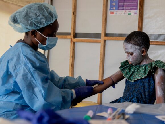 Africa’s Ivory Coast has reported cases of mpox Clade 2, according to the World Health Organization