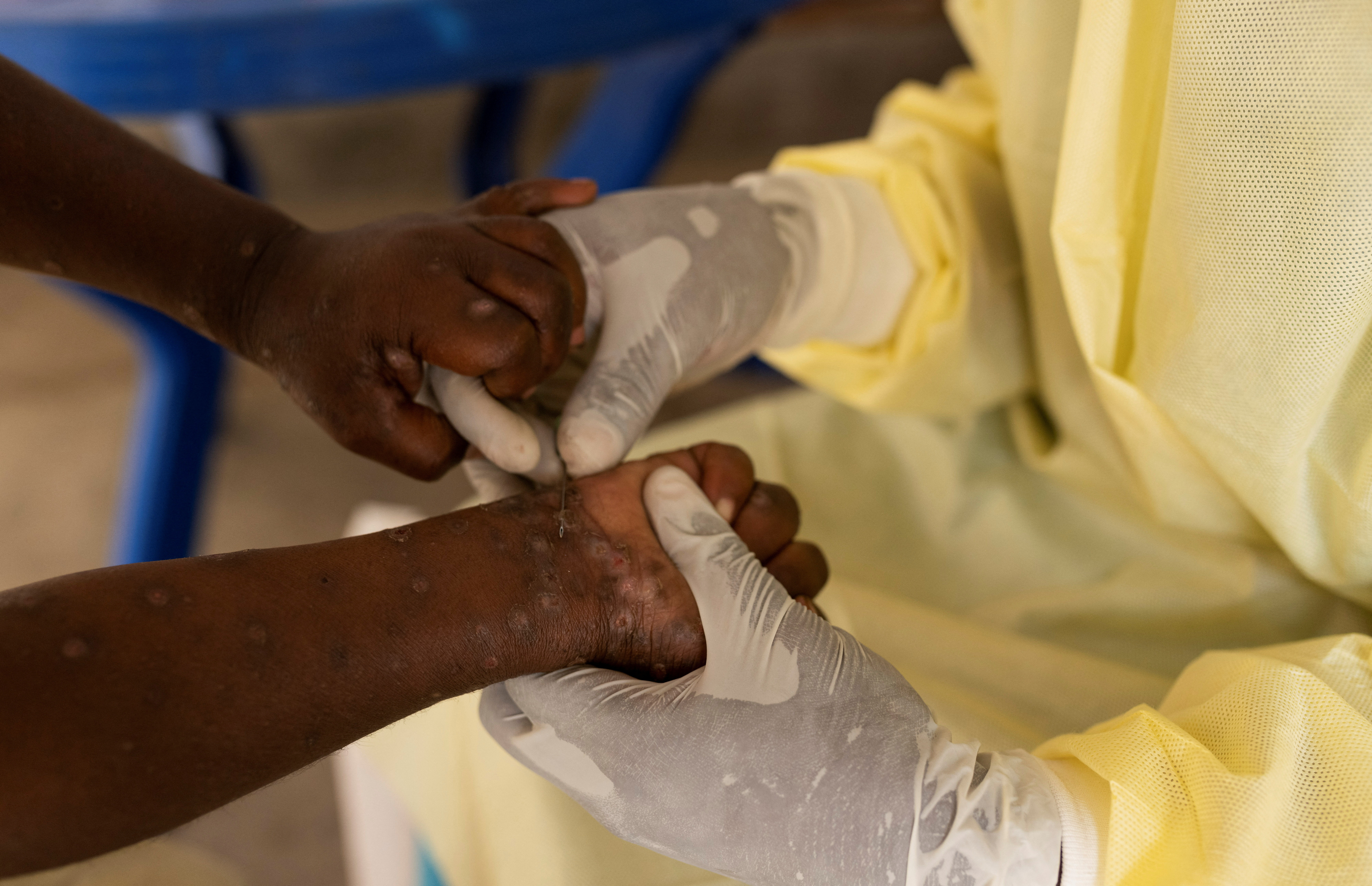 Next week, Congo anticipates receiving its initial mpox vaccines