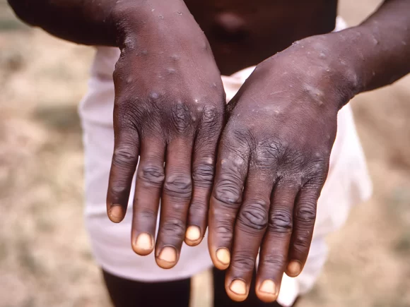 Kenya reports a second case of Mpox