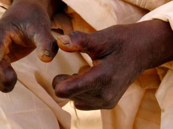 Nigeria will finally get leprosy medications after a year-long wait