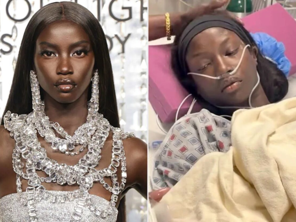 Supermodel Anok Yai had surgery to correct a congenital defect