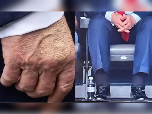 White House doctor says Trump is fit for duty even though his legs and hands are swollen and bruised
